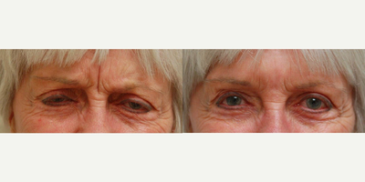 Botox before and after photo