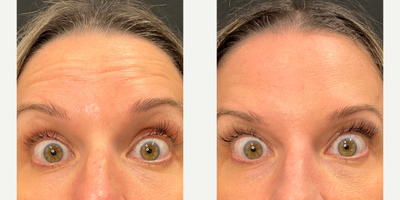 Botox before and after photo