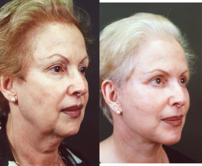 Chin Implant before and after photo