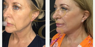 Facelift before and after photo