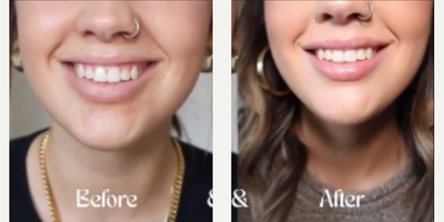 Restylane Kysse before and after photo