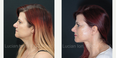 SMAS Facelift before and after photo