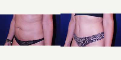 Tummy Tuck before and after photo