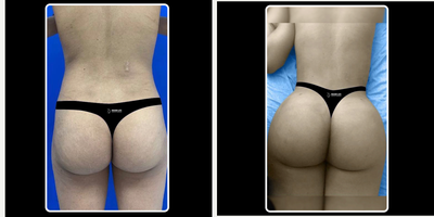 Brazilian Butt Lift before and after photo
