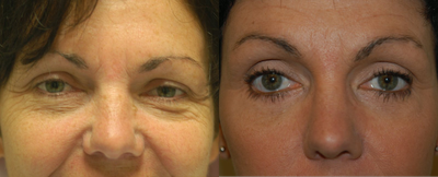Eyelid Surgery before and after photo