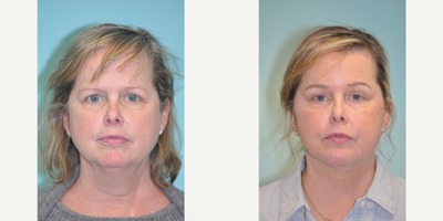 Facelift before and after photo