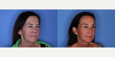 Facelift before and after photo