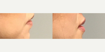 Lip Fillers before and after photo
