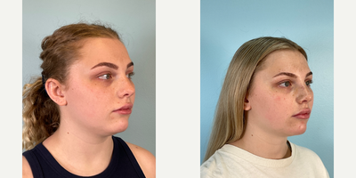 Rhinoplasty before and after photo