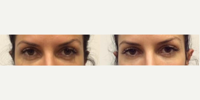 Voluma before and after photo