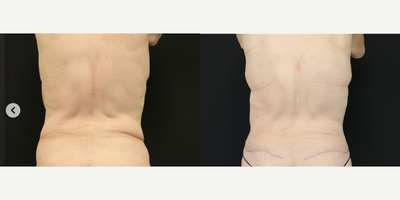 Body Lift before and after photo