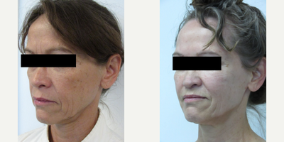 Botox before and after photo