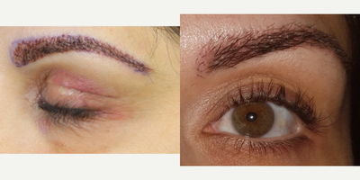 Eyebrow Transplant before and after photo