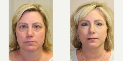 Eyelid Surgery before and after photo