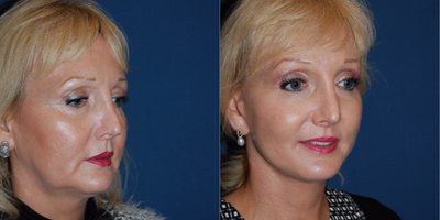 Facelift before and after photo