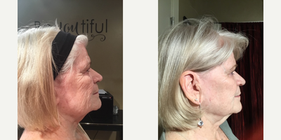 Microneedling before and after photo