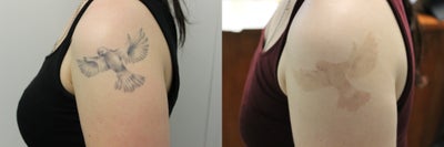 PicoSure before and after photo