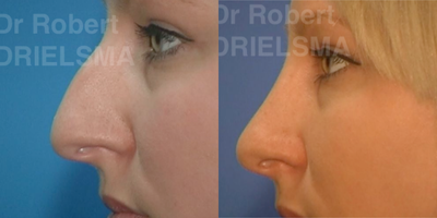 Rhinoplasty before and after photo