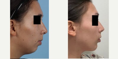 Chin Implant before and after photo