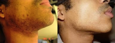 Laser Hair Removal before and after photo