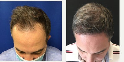 NeoGraft before and after photo