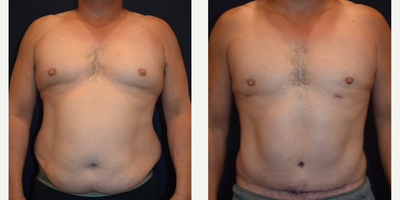 Tummy Tuck before and after photo