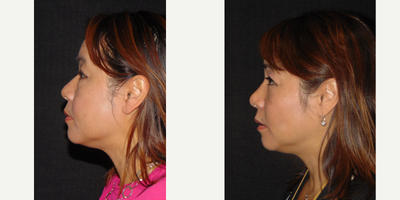Asian Rhinoplasty before and after photo