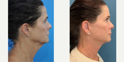 Brow Lift before and after photo
