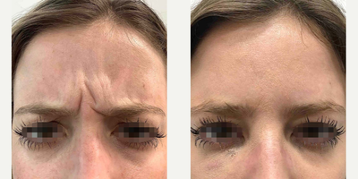 Dysport before and after photo