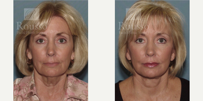 Facelift before and after photo