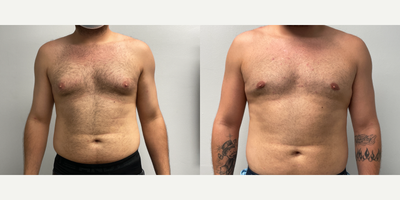 Gynecomastia Surgery before and after photo