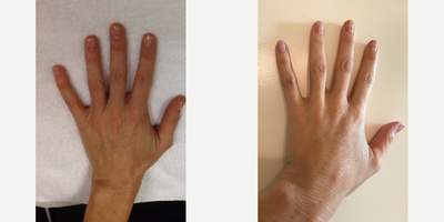 Hand Rejuvenation before and after photo
