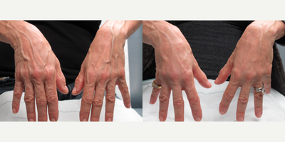 Hand Rejuvenation before and after photo