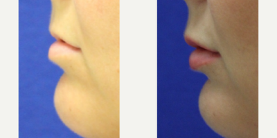 Lip Fillers before and after photo