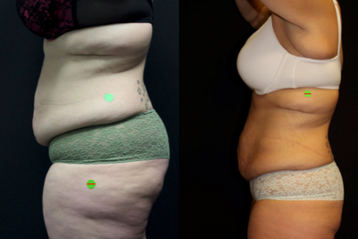 Skin Tightening before and after photo