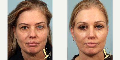 Brow Lift before and after photo