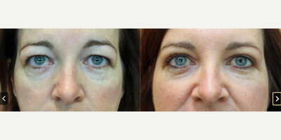 Eyelid Surgery before and after photo