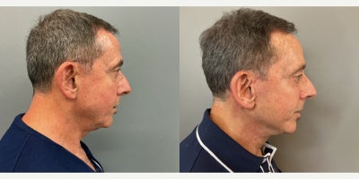 Facelift before and after photo