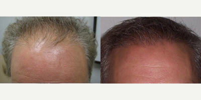 Hair Transplant before and after photo