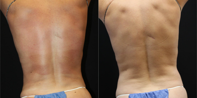 Laser Liposuction before and after photo