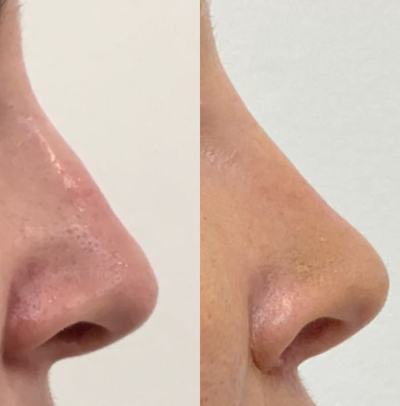 Nonsurgical Nose Job before and after photo