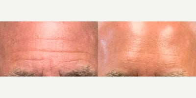 Botox before and after photo