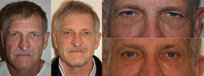 Brow Lift before and after photo