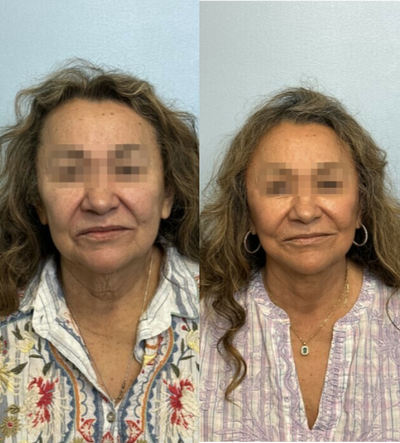 Deep Plane Facelift before and after photo