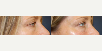 Dermal Fillers before and after photo