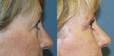 Eyelid Surgery before and after photo