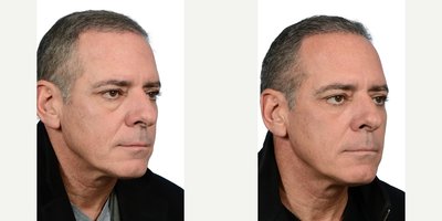 Eyelid Surgery before and after photo