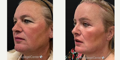 Facial Feminization Surgery before and after photo