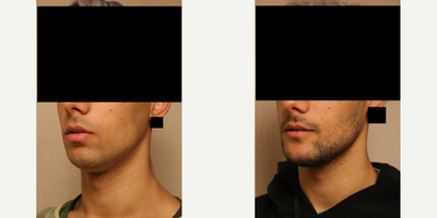 Genioplasty before and after photo