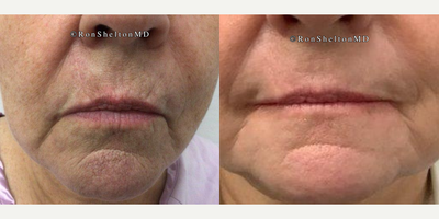 Laser Resurfacing before and after photo